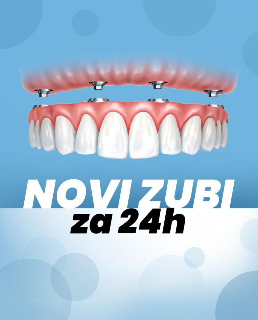 Zubni-implantati-All-on-Four-za-24h