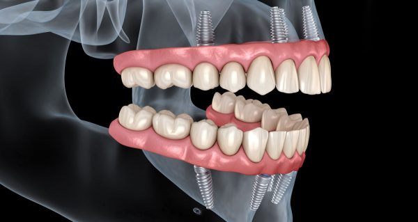 Implantati All on four - All on six