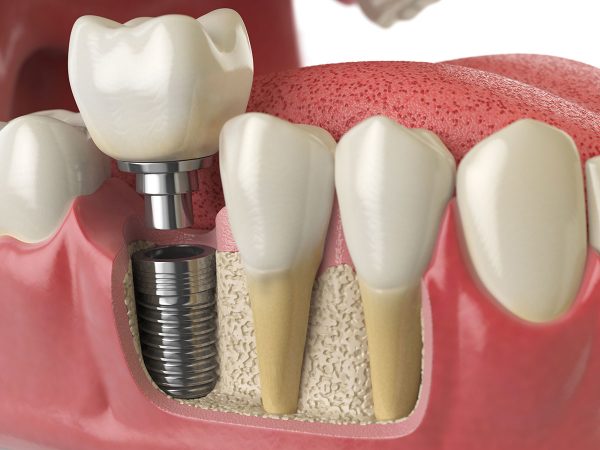 Proces ugradnje-zubnih implantata - Ardent Implant Centar
